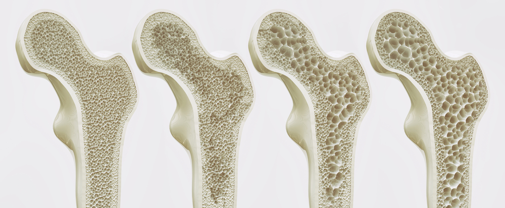 ilustração de ossos com osteoporose