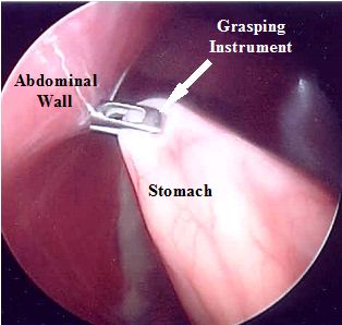 imagem de laparoscopia da região gástrica